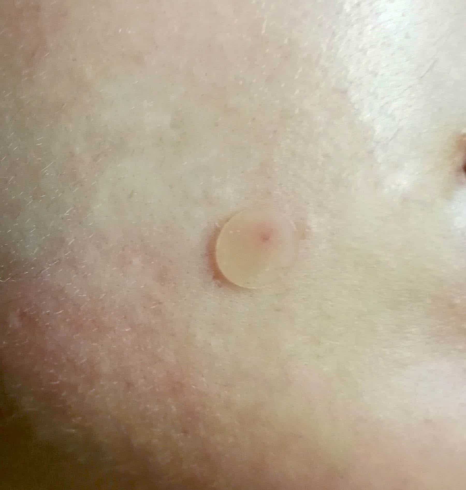 Acne Pimple Master Patch auf der Haut