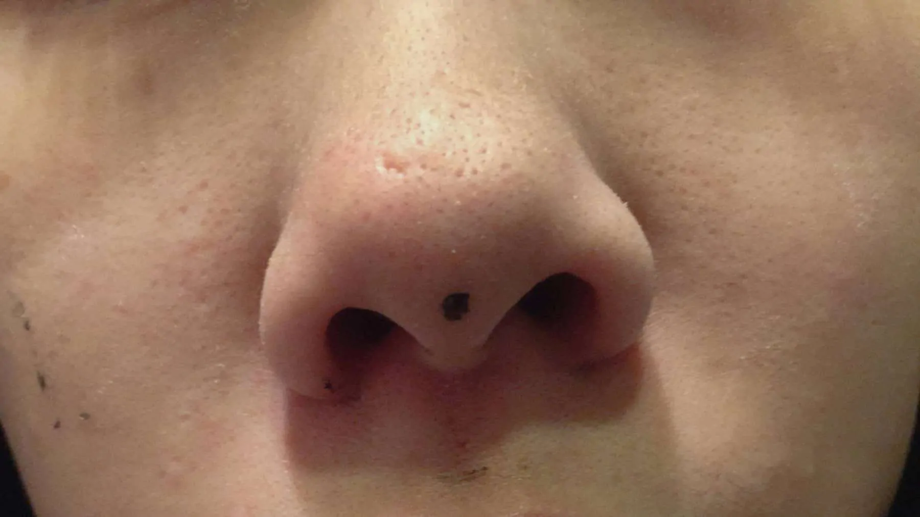Nase nach der My Scheming Maske