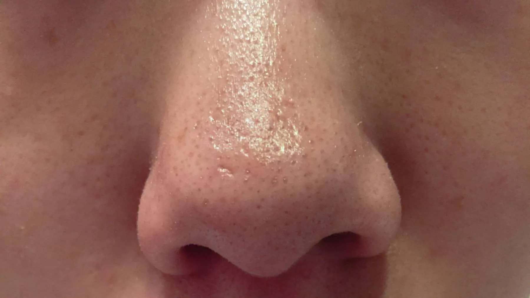 Nase mit Mitessern vor der My Scheming Maske